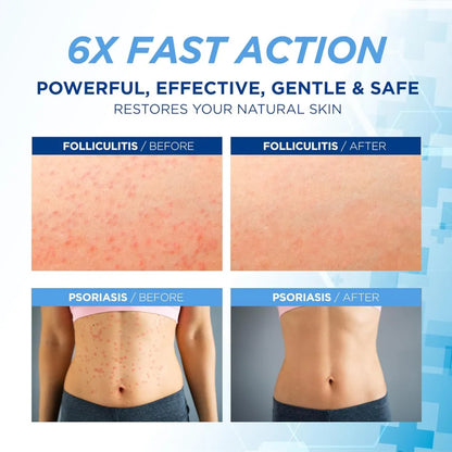 Folliculitis Treatment Cream: Effective Treatment for Folliculitis Scalp Face and Body 100g