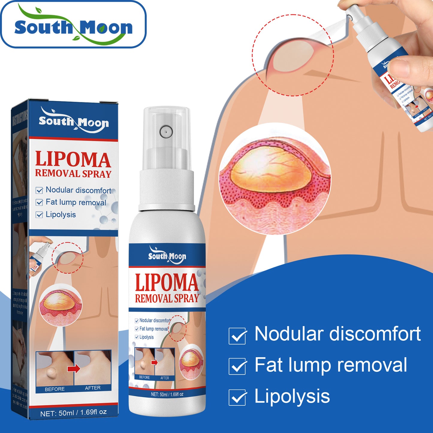 LIPOMA REMOVAL SPRAY (IMPORTED)